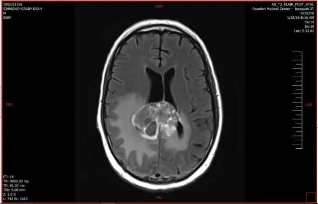 Brain scan showing a glioblastoma tumor potentially linked to chronic Lyme disease